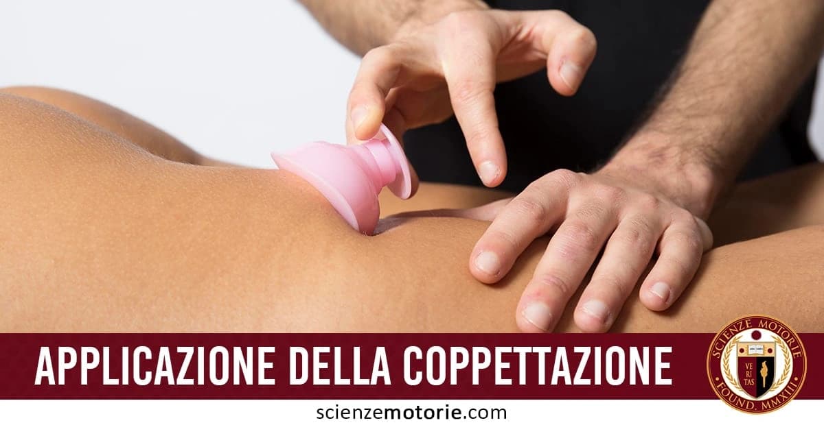 L'immagine mostra l'applicazione della coppettazione, una tecnica terapeutica utilizzata in medicina tradizionale per stimolare la circolazione sanguigna e alleviare dolori muscolari. La scena si concentra su un'area del corpo scoperta, con una coppetta posizionata sulla pelle. In fondo all'immagine, è presente il testo "APPLICAZIONE DELLA COPPETTAZIONE", con il logo di scienzemotorie.com,