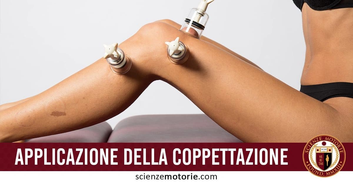 Persona sdraiata su un lettino con coppette applicate sulle gambe per un trattamento di coppettazione terapeutica. In basso, il testo "Applicazione della Coppettazione" e il logo di Scienze Motorie
