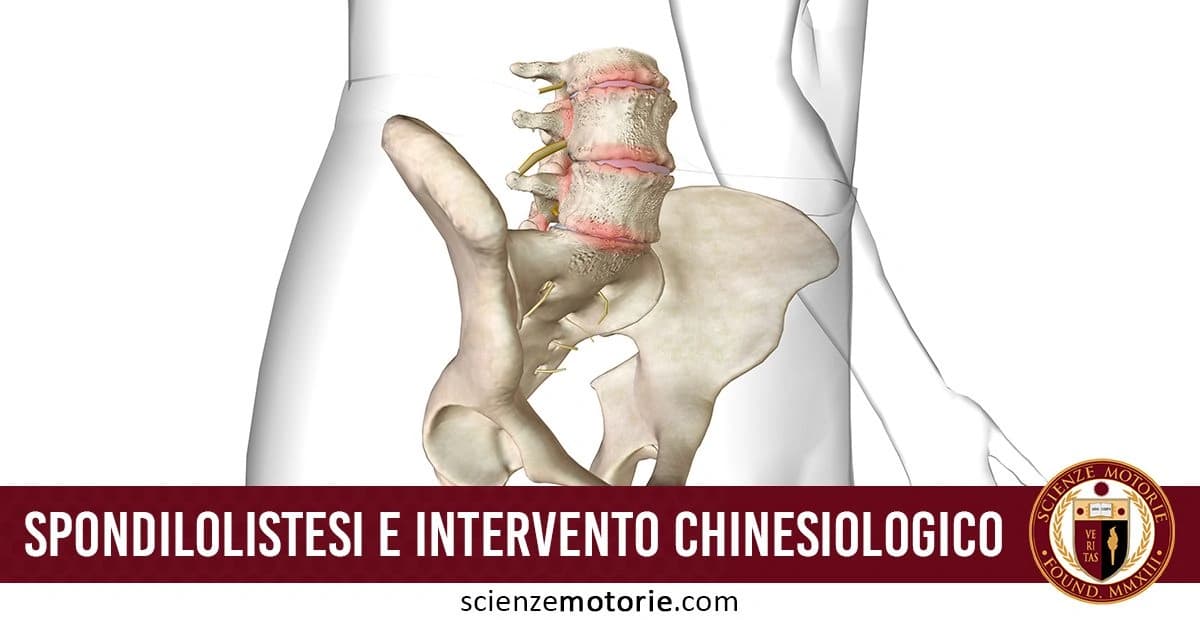 L’immagine mostra un’illustrazione medica che evidenzia la spondilolistesi, una condizione in cui una vertebra scivola in avanti rispetto alla vertebra sottostante. L’area interessata della colonna vertebrale inferiore e il bacino sono ben visibili. Nella parte inferiore dell’immagine, un testo recita “Spondilolistesi e intervento chinesiologico,” accompagnato dal logo di Scienze Motorie