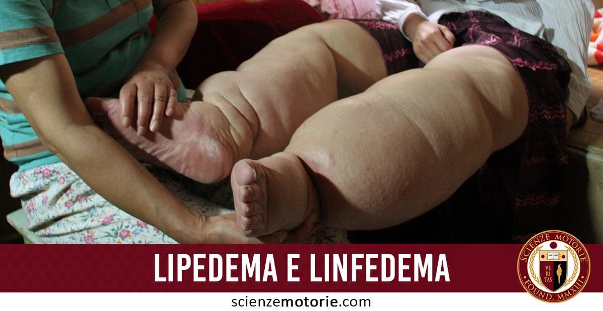 Due persone sedute, una con gambe gonfie affette da lipedema o linfedema, mentre l’altra applica un trattamento manuale. in basso a destra si può notare il logo di ScienzeMotorie.com