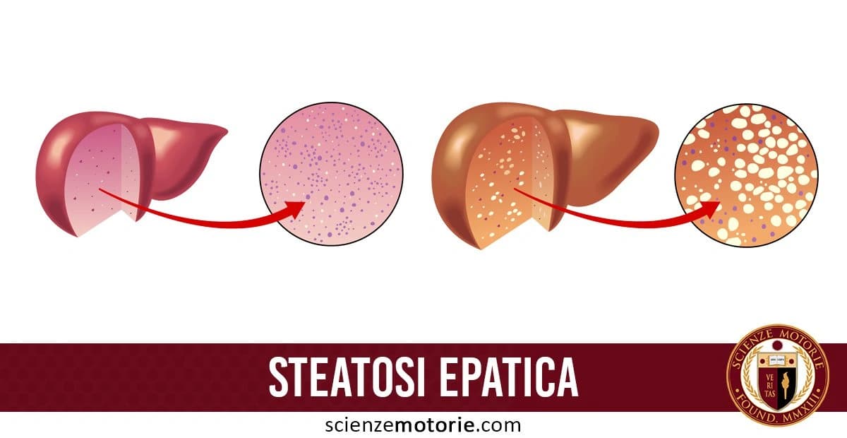 Confronto visivo tra un fegato sano e un fegato affetto da steatosi epatica, con dettagli cellulari e accumuli di grasso evidenziati. In basso a destra è presente il logo di ScienzeMotorie.com