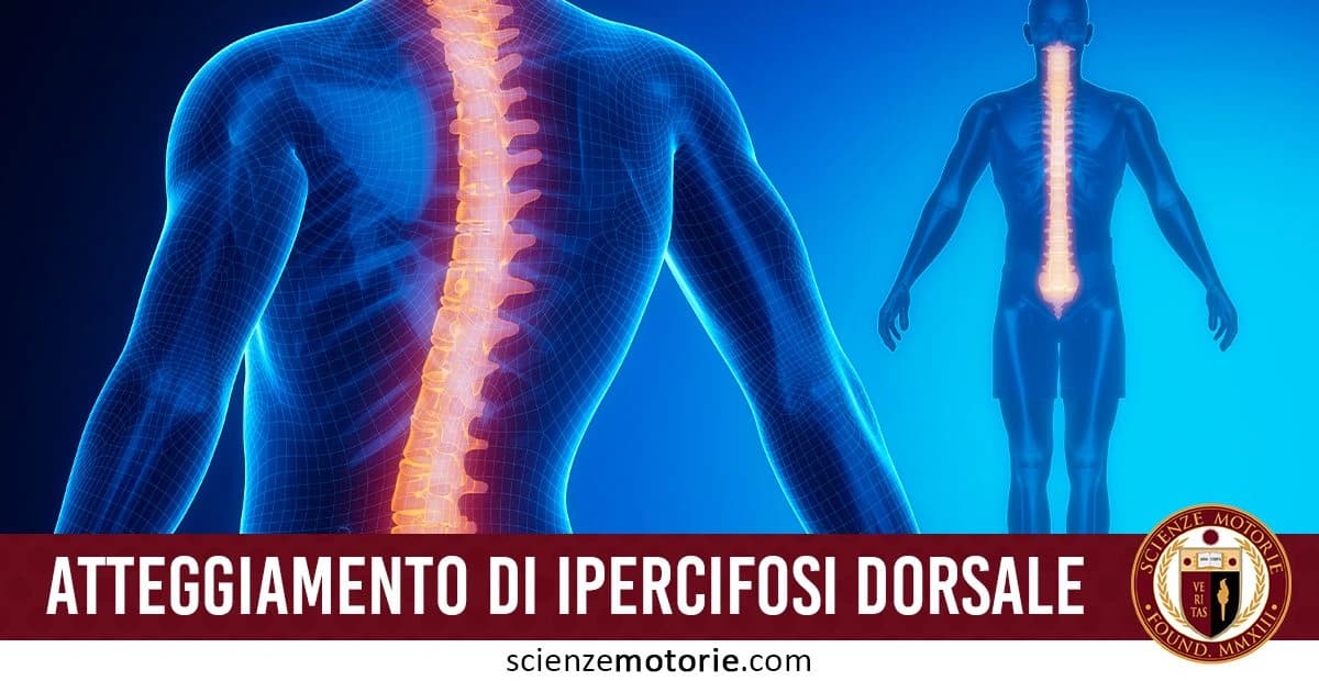 Due sagome umane stilizzate con la colonna vertebrale evidenziata, mostrando un atteggiamento di ipercifosi dorsale. In basso, il testo 'ATTEGGIAMENTO DI IPERCIFOSI DORSALE' e il logo di ScienzeMotorie.com