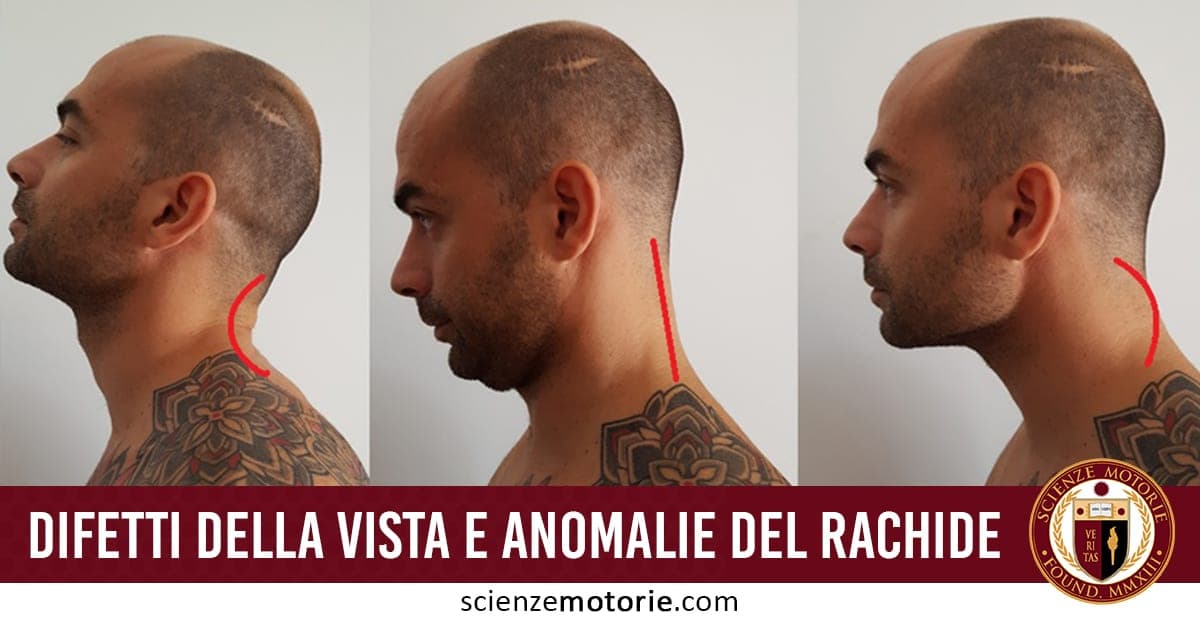 Tre profili di una persona con diverse posture cervicali, curvatura del rachide evidenziata, testo "Difetti della vista e anomalie del rachide", logo Scienze Motorie.
