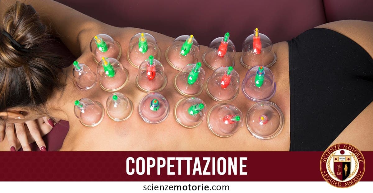 L’immagine mostra una persona sdraiata a pancia in giù su un lettino, con diverse coppette per la coppettazione applicate sulla sua schiena. Le coppette, di plastica trasparente e dotate di valvole colorate, creano un effetto di suzione sulla pelle, una tecnica utilizzata in medicina alternativa per favorire il miglioramento della circolazione, alleviare dolori muscolari e trattare disturbi fisici. Il testo sotto l’immagine, che recita "COPPETTAZIONE" accompagnata dal logo Scienze Motorie
