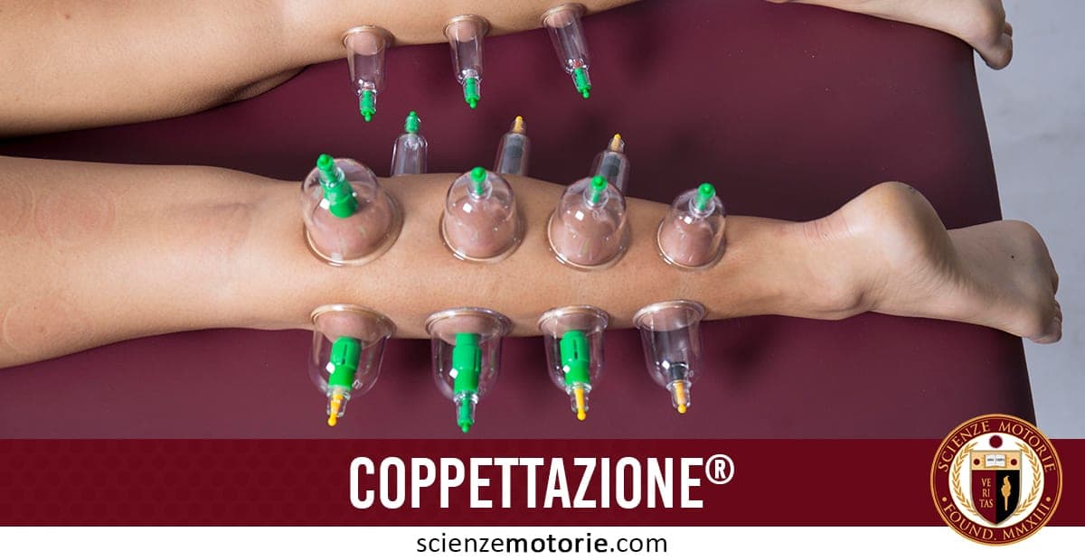 Coppettazione su gambe di persona sdraiata, con coppette trasparenti applicate tramite aspirazione; in basso il logo di scienzemotorie.com ben visibile.