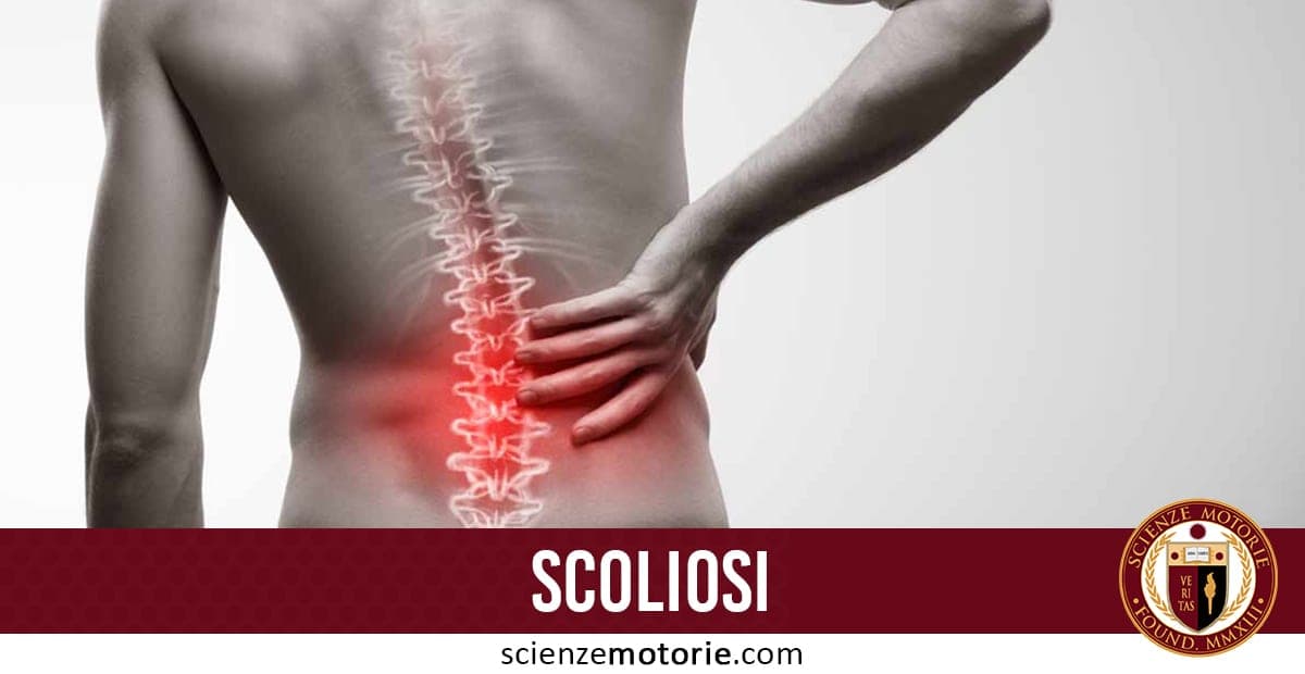 L’immagine mostra una persona di spalle con una mano sulla parte bassa della schiena, evidenziando dolore lombare. La colonna vertebrale, evidenziata graficamente, presenta una curvatura anomala tipica della scoliosi. Il rossore nella zona lombare indica infiammazione o tensione. Il testo “SCOLIOSI” e l’indirizzo scienzemotorie.com
