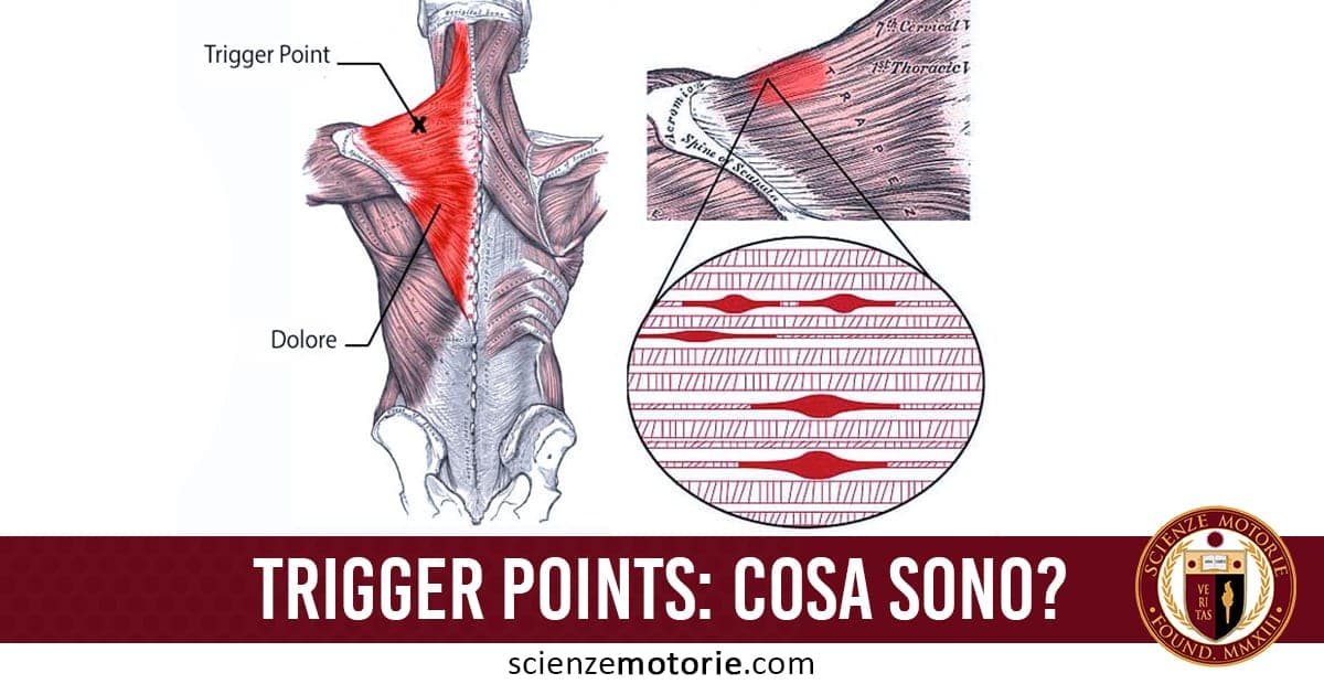 Illustrazione anatomica dei trigger points nella schiena, con indicazioni delle aree dolorose e dettagli delle fibre muscolari coinvolte.