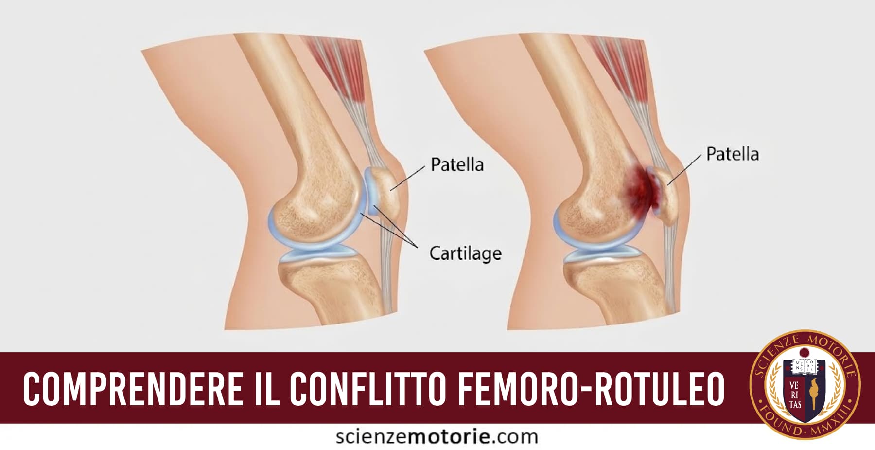 Dolore anteriore del ginocchio: comprendere il conflitto femoro-rotuleo