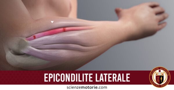 Epicondilite Laterale