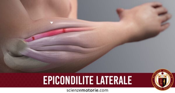 Epicondilite Laterale