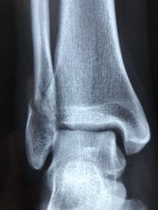 Caviglia: Anatomia e Tipologie di Lesioni
