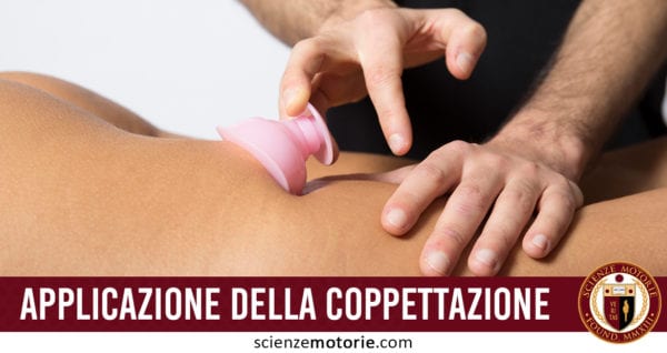 applicazione della coppettazione