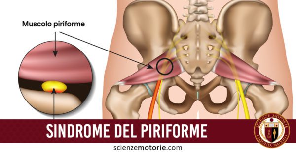 Sindrome del muscolo piriforme