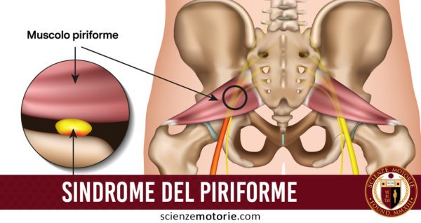 Sindrome del muscolo piriforme