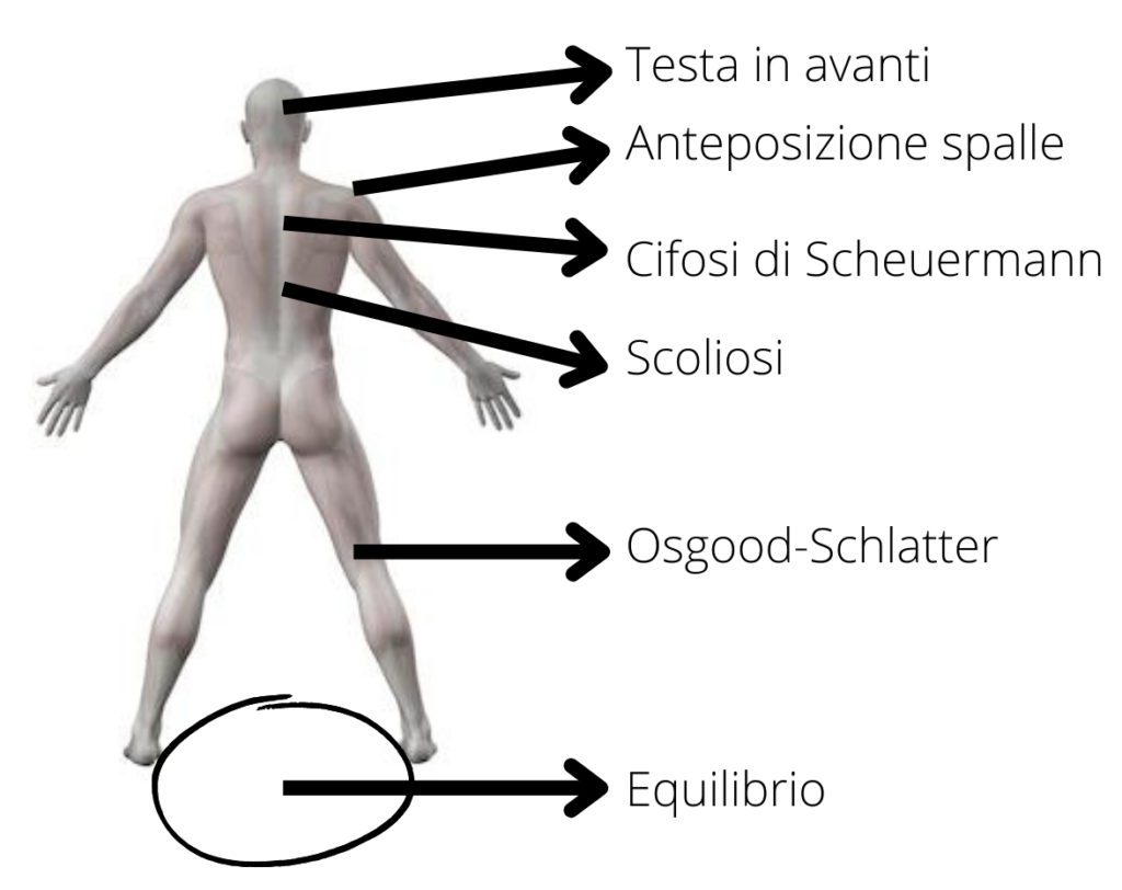 scoliosi e cifosi nell'adolescente