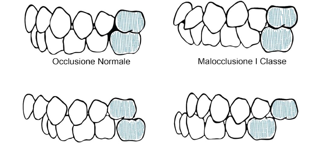 classificazione dell'occlusione