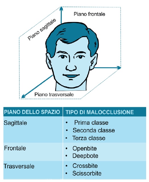 malocclusioni in riferimento ai piani dello spazio