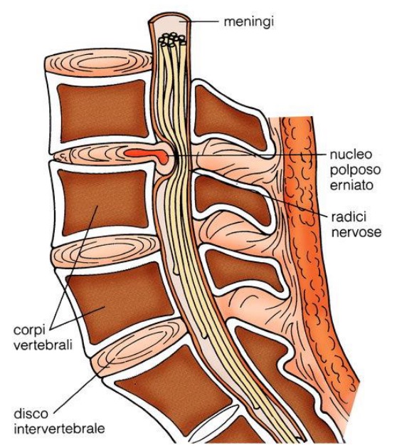 Ernia del disco
